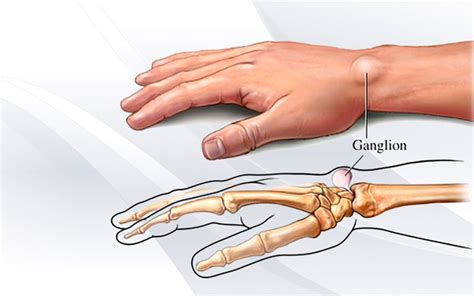 ganglion cyst - Quality Foot Care