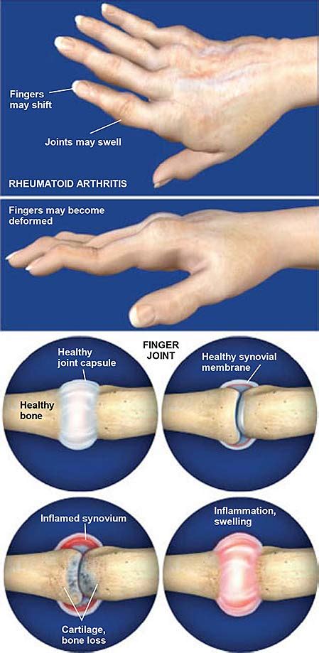 Rheumatoid Arthritis (RA) of the Hand | Central Coast Orthopedic Medical Group