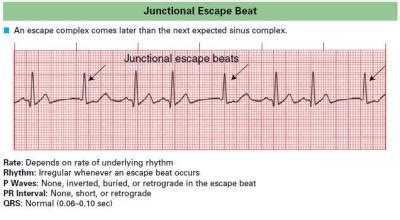 Junctional Rhythm