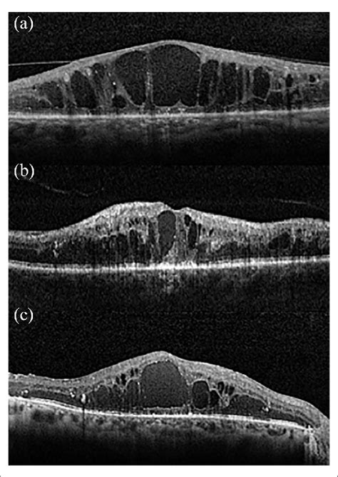 Severe diabetic maculopathy. | Download Scientific Diagram