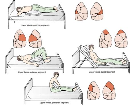 Chest Physiotherapy - Noninvasive Respiratory Therapies (2022)