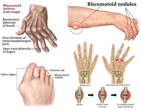 Rheumatoid Arthritis Joints