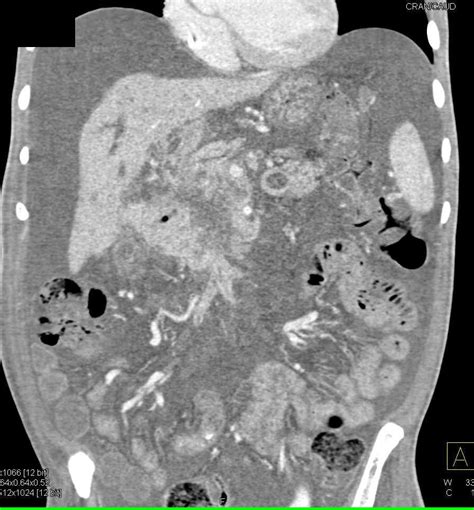 Pneumatosis Coli in Cirrhotic Patient / CTisus.com | Colon, Case study, Patient