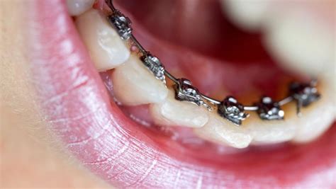 Lingual Braces - Smile Studio - Dental Clinic