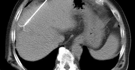 Cervical Radiofrequency Ablation | Wake Spine & Pain