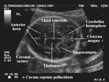 biparietal diameter images | After the 20 th week of gestation, the ...