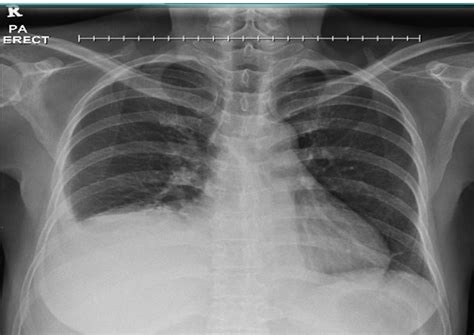 Elevated hemidiaphragm – Radiology Cases