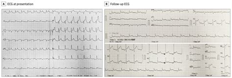 STEMI or Pericarditis? How to Tell the Difference - JournalFeed