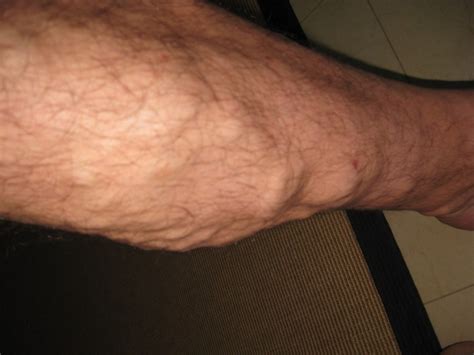 [Health] suddenly swollen and sore leg, should know in advance ‘varicose veins early symptoms’