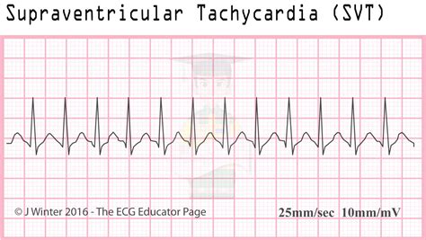 ECG Educator Blog : Atrial Rhythms