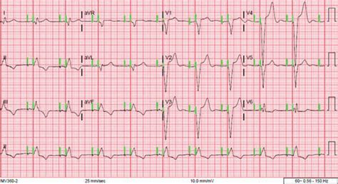 Atrioventricular paced rhythm. | Download Scientific Diagram