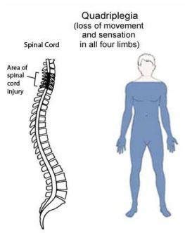 spastic quadriplegia treatment Archives - Samarpan Physiotherapy Clinic