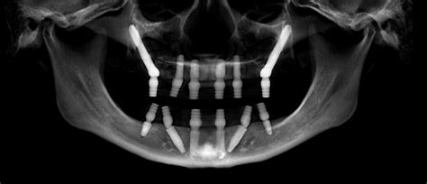 Can You Have Dental Implants with Severe Bone Loss? | New Teeth Now