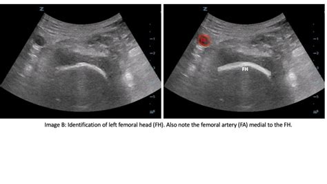 Pericapsular Nerve Group (PENG) Block for patients with hip or pelvis fractures in the ED | EM ...