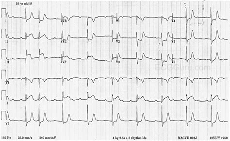 Inferior-posterior Wall M.I. and AV Dissociation | ECG Guru - Instructor Resources