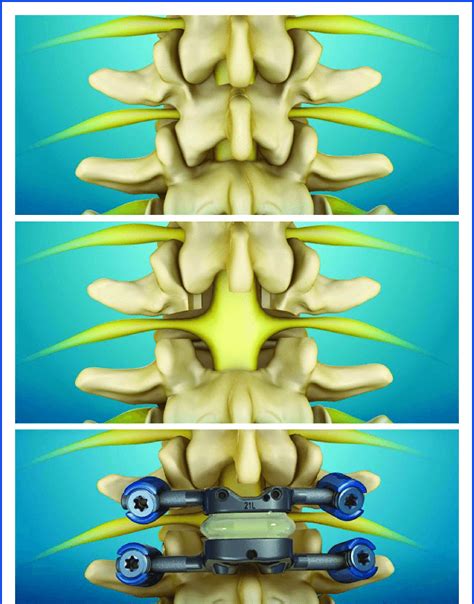 Total posterior spine system implant in situ. FIGURE 3. Illustration of... | Download Scientific ...