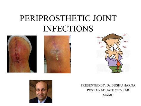 Periprosthetic Joint Infection | PPT