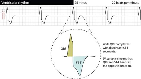 Ventricular rhythm and accelerated ventricular rhythm (idioventricular rhythm) – ECG learning