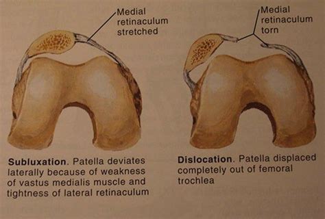 Image result for What causes patellar tracking disorder? | Patellar tracking disorder ...