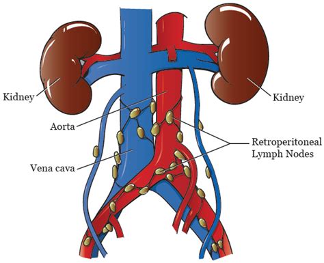 Para Aortic Lymph Node Cancer Treatment