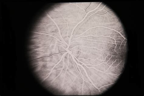 Optic Nerve Meningioma - Retina Image Bank