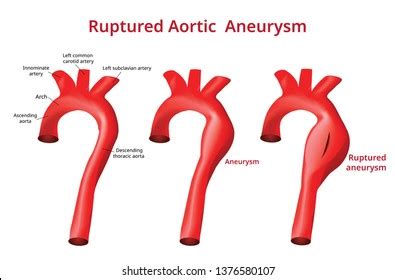 Ruptured Aortic Aneurysm Aortic Disease Vector Stock Vector (Royalty Free) 1376580107 | Shutterstock