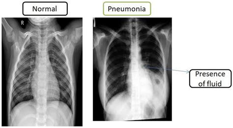 Difference in Chest X Ray Images in Normal and Pneumonia | Download ...