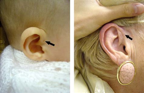 Congenital preauricular sinus | Semantic Scholar