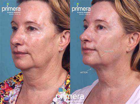 Ultherapy® Before and After Pictures Case 385 | Orlando, Florida | Primera Plastic Surgery