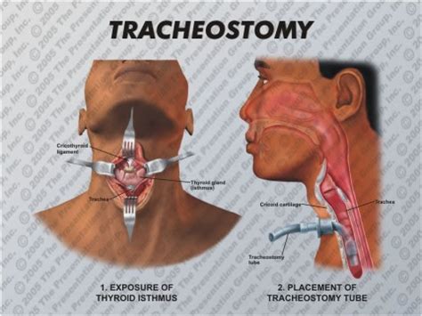 Regaining Speech After a Tracheotomy