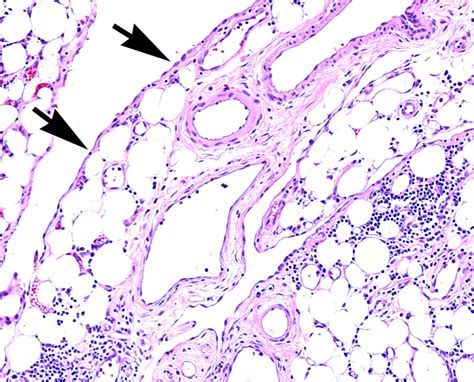 Primary Peritoneal Tumors: Imaging Features with Pathologic Correlation | RadioGraphics