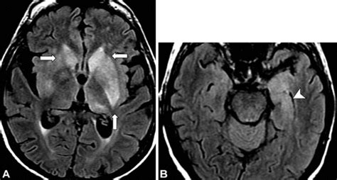 Parahippocampal Gyrus Mri