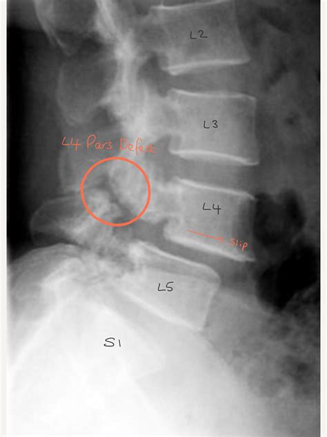 Pars Defect Repair - Spines Dorset