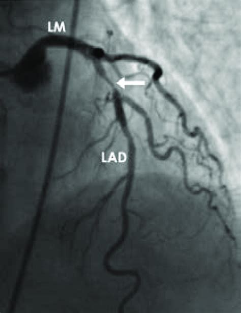 -Left Coronary Artery Angiogram. In this coronary angiogram of the left... | Download Scientific ...