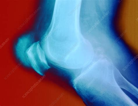 Knee with gout, X-ray - Stock Image - C021/5429 - Science Photo Library