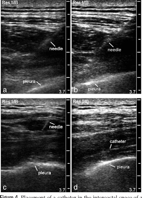 Figure 1 from Ultrasound-Guided Paravertebral Block Using an ...