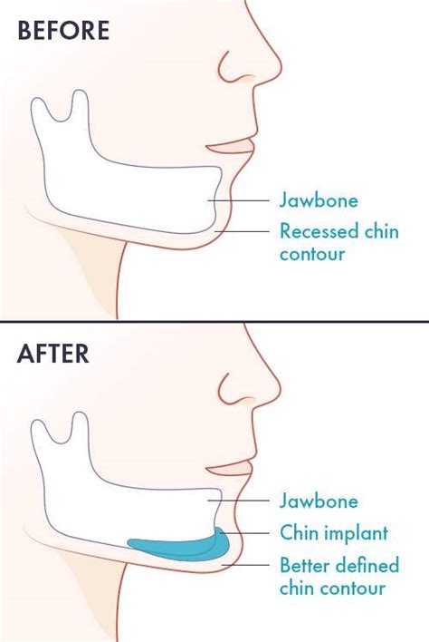 Chin correction surgery is a great way to improve your facial appearanceMedisetter