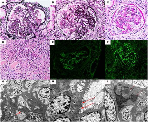 Frontiers | Diverse Clinical Presentations of C3 Dominant ...