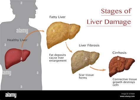 Fatty Liver Disease Stages