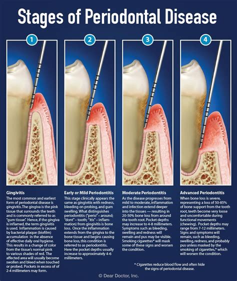 Understanding Periodontal Pockets