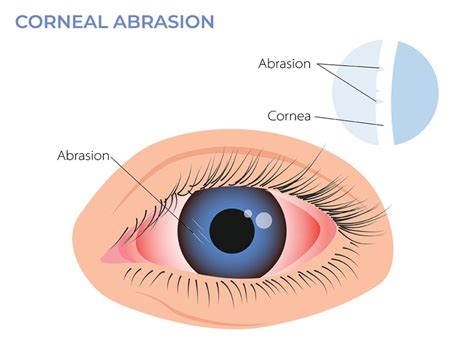 Corneal Abrasions - Santa Monica Eye Group