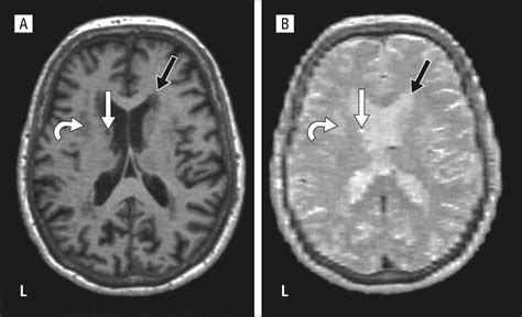 White Matter Lesions Are Prevalent but Differentially Related With ...