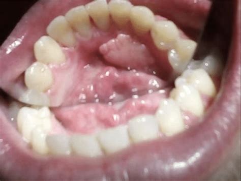 b: Traumatic fibroma in the oral floor in a 47 years old good health... | Download Scientific ...