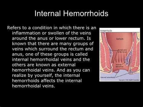 Hemorrhoids 1235093240420575 1