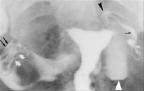 n 34-year-old infertile woman, hysterosalpingogram shows radiographic ...