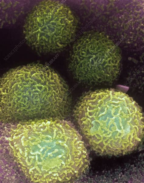 Colon cancer cells - Stock Image - M132/0586 - Science Photo Library