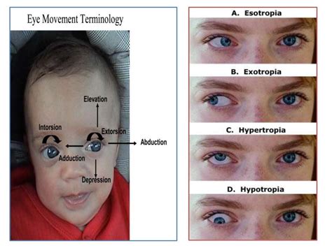 Oculomotor palsy