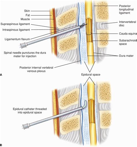 Obstetrical Analgesia and Anesthesia | Obgyn Key