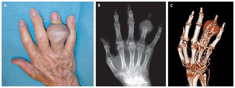 Metastasis of Renal-Cell Carcinoma | NEJM