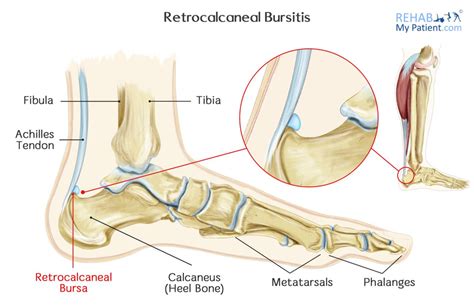 Achilles Bursitis Retrocalcaneal Bursitis Symptoms, Causes Treatment ...